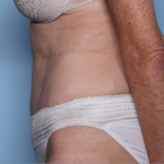 Tummy Tuck Before & After Patient #34668