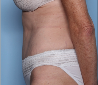 Tummy Tuck Before & After Patient #34668