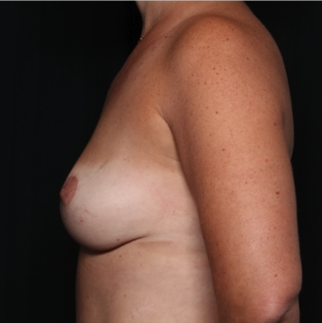 Breast Lift Before & After Patient #34710