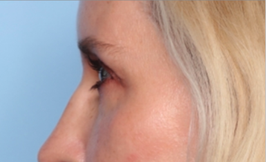 Blepharoplasty Before & After Patient #34649