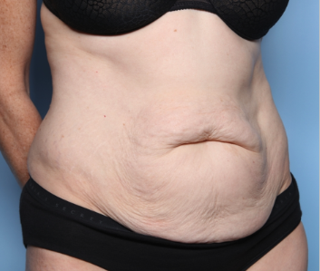 Tummy Tuck Before & After Patient #34668