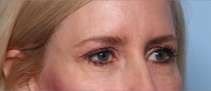 Blepharoplasty Before & After Patient #34649