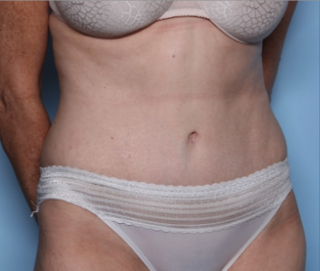 Tummy Tuck Before & After Patient #34668