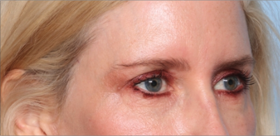 Blepharoplasty Before & After Patient #34649