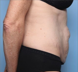 Tummy Tuck Before & After Patient #34668