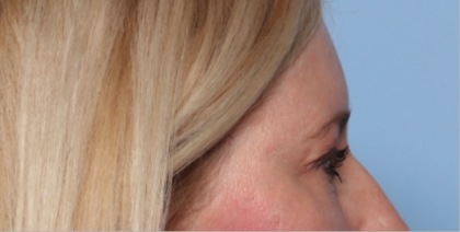 Blepharoplasty Before & After Patient #34649