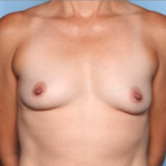 Breast Lift with Implant Before & After Patient #34746