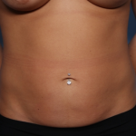 Tummy Tuck Before & After Patient #34834