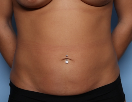 Tummy Tuck Before & After Patient #34834