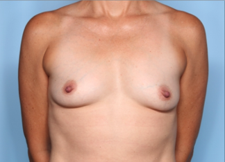 Breast Lift with Implant Before & After Patient #34746