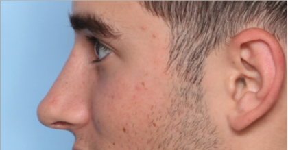 Rhinoplasty Before & After Patient #34768