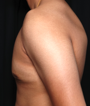 Gynecomastia Before & After Patient #34812