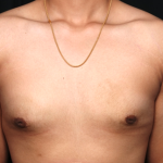 Gynecomastia Before & After Patient #34812