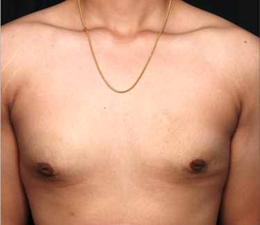 Gynecomastia Before & After Patient #34812