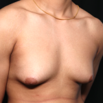 Gynecomastia Before & After Patient #34812