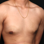 Gynecomastia Before & After Patient #34812