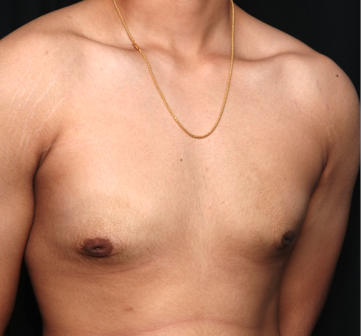 Gynecomastia Before & After Patient #34812