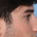 Rhinoplasty Before & After Patient #34768