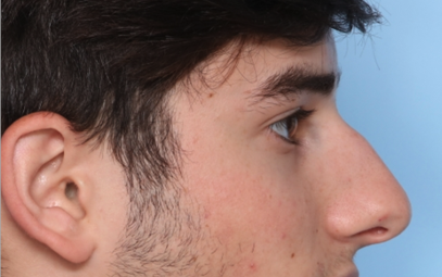 Rhinoplasty Before & After Patient #34768