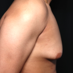 Gynecomastia Before & After Patient #34812