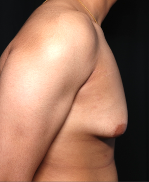 Gynecomastia Before & After Patient #34812