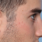 Rhinoplasty Before & After Patient #34768