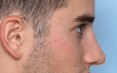 Rhinoplasty Before & After Patient #34768