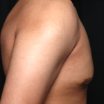 Gynecomastia Before & After Patient #34812