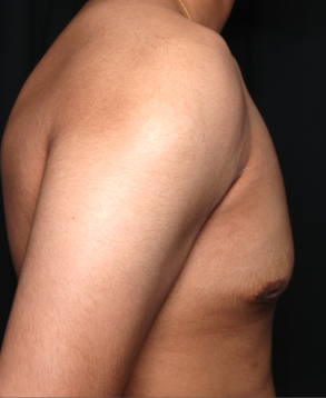 Gynecomastia Before & After Patient #34812