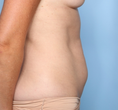 Tummy Tuck Before & After Patient #34823