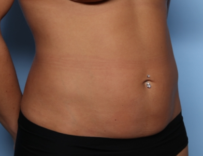 Tummy Tuck Before & After Patient #34834