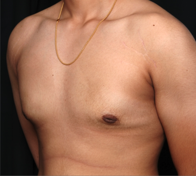 Gynecomastia Before & After Patient #34812