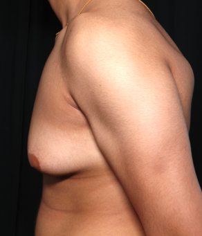 Gynecomastia Before & After Patient #34812