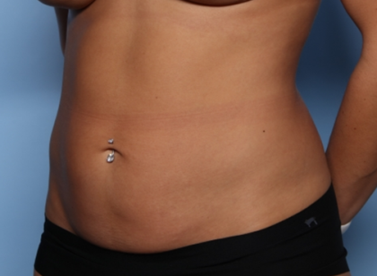 Tummy Tuck Before & After Patient #34834