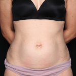 Tummy Tuck Before & After Patient #34911