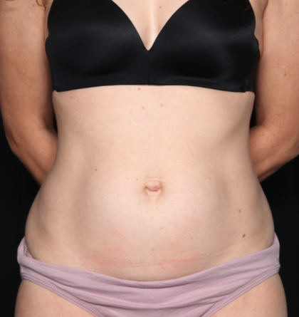 Tummy Tuck Before & After Patient #34911