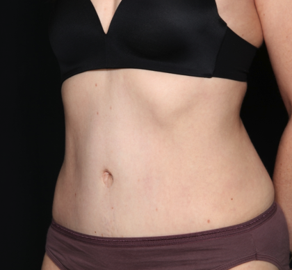 Tummy Tuck Before & After Patient #34911