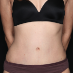 Tummy Tuck Before & After Patient #34911