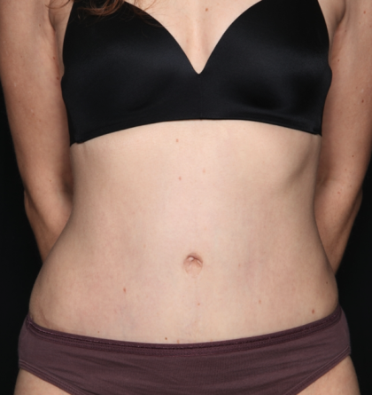 Tummy Tuck Before & After Patient #34911