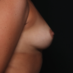 Breast Augmentation Before & After Patient #34889