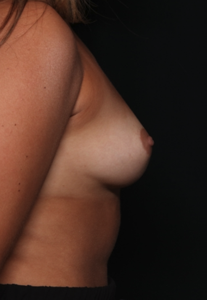 Breast Augmentation Before & After Patient #34889