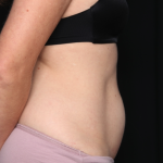 Tummy Tuck Before & After Patient #34911