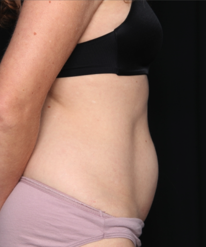 Tummy Tuck Before & After Patient #34911