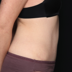 Tummy Tuck Before & After Patient #34911