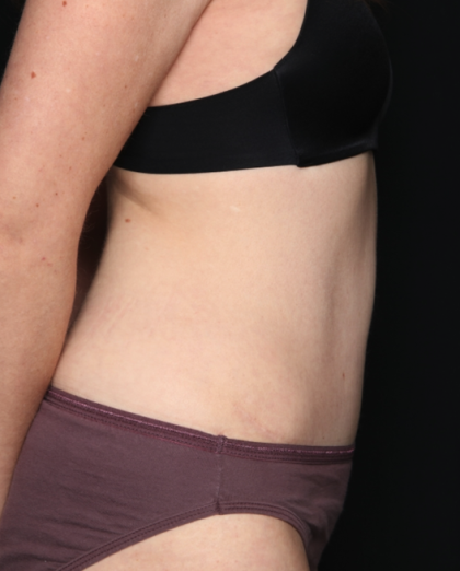 Tummy Tuck Before & After Patient #34911