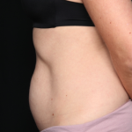 Tummy Tuck Before & After Patient #34911