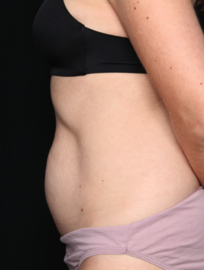 Tummy Tuck Before & After Patient #34911