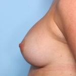 Breast Augmentation Before & After Patient #34890