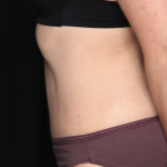 Tummy Tuck Before & After Patient #34911