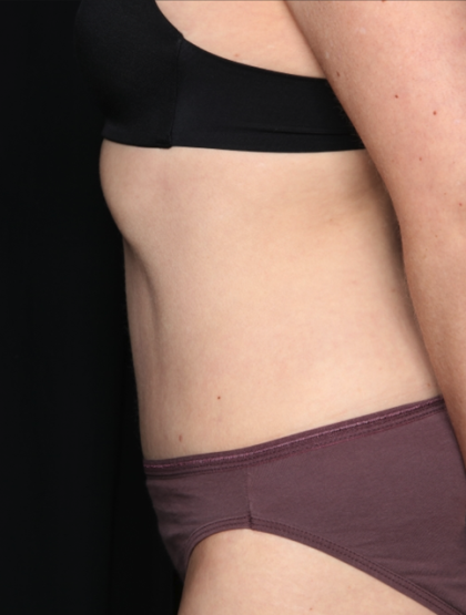 Tummy Tuck Before & After Patient #34911